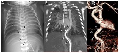 Neonatal Arterial Tortuosity and Adult Aortic Aneurysm—Is There a Missing Link?—A Case Report